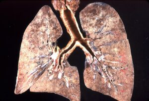 Image of human lungs infected with Pneumocystis jiroveci